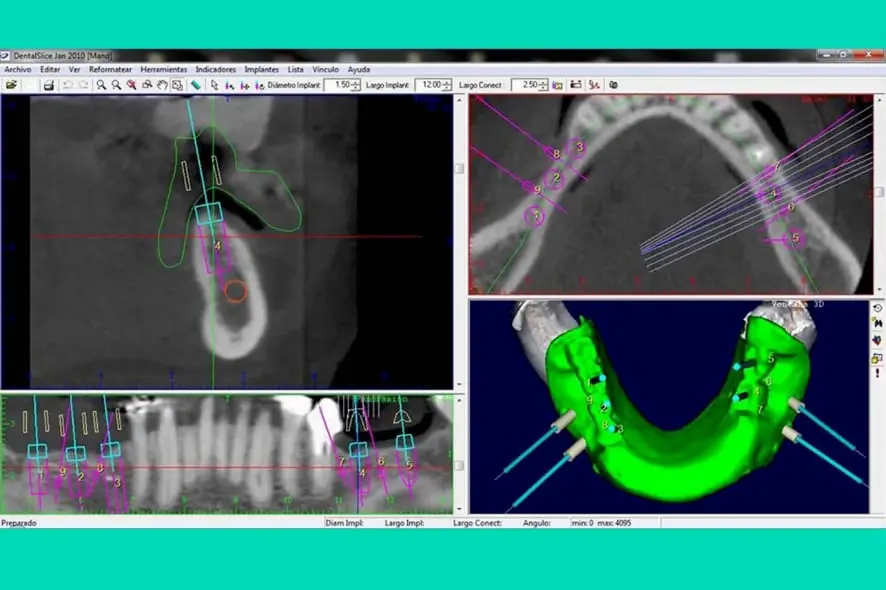 implantes dentários