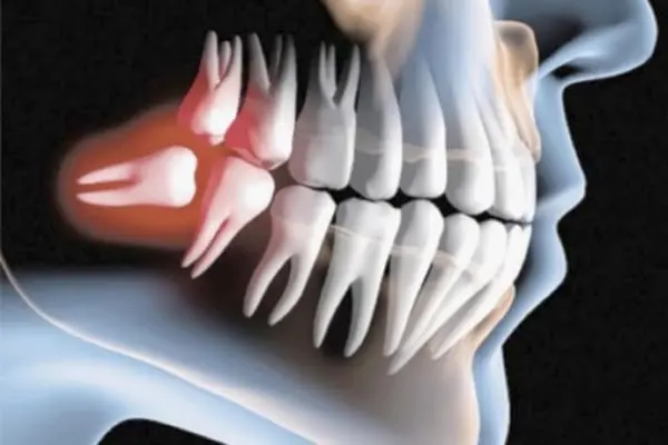 DENTE SISO