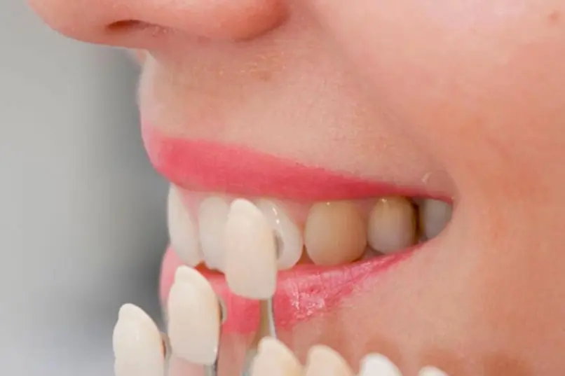 lentes de contato dental