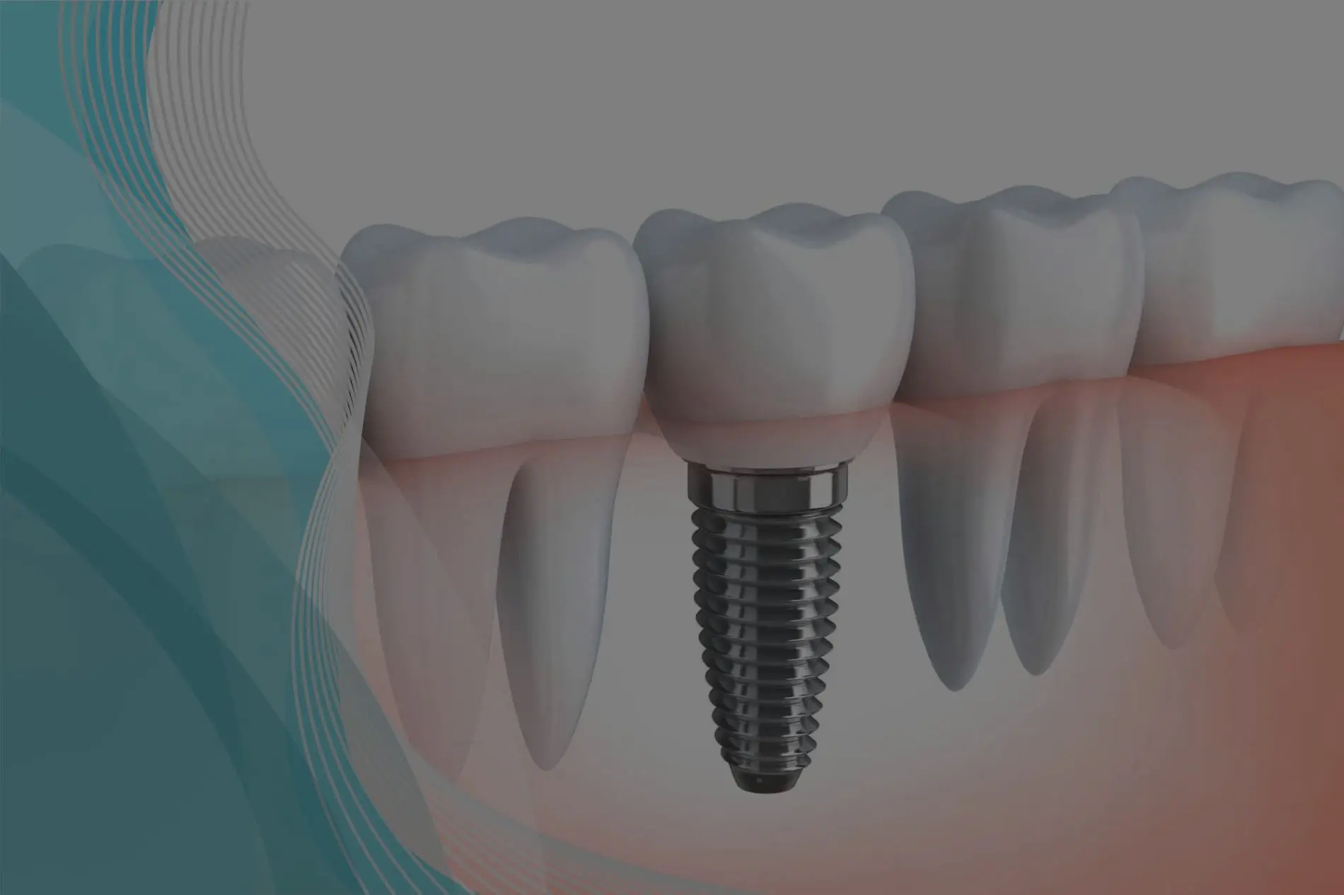 SOMMOS ODONTOLOGIA IMPLANTES