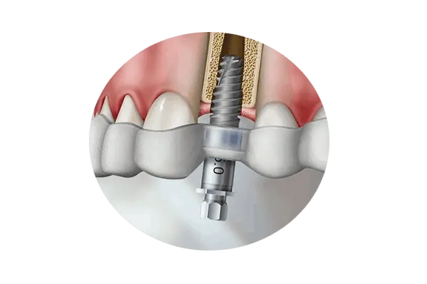 Cirurgia Guiada